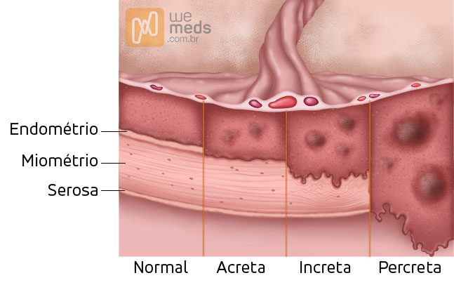 acretismo placentário