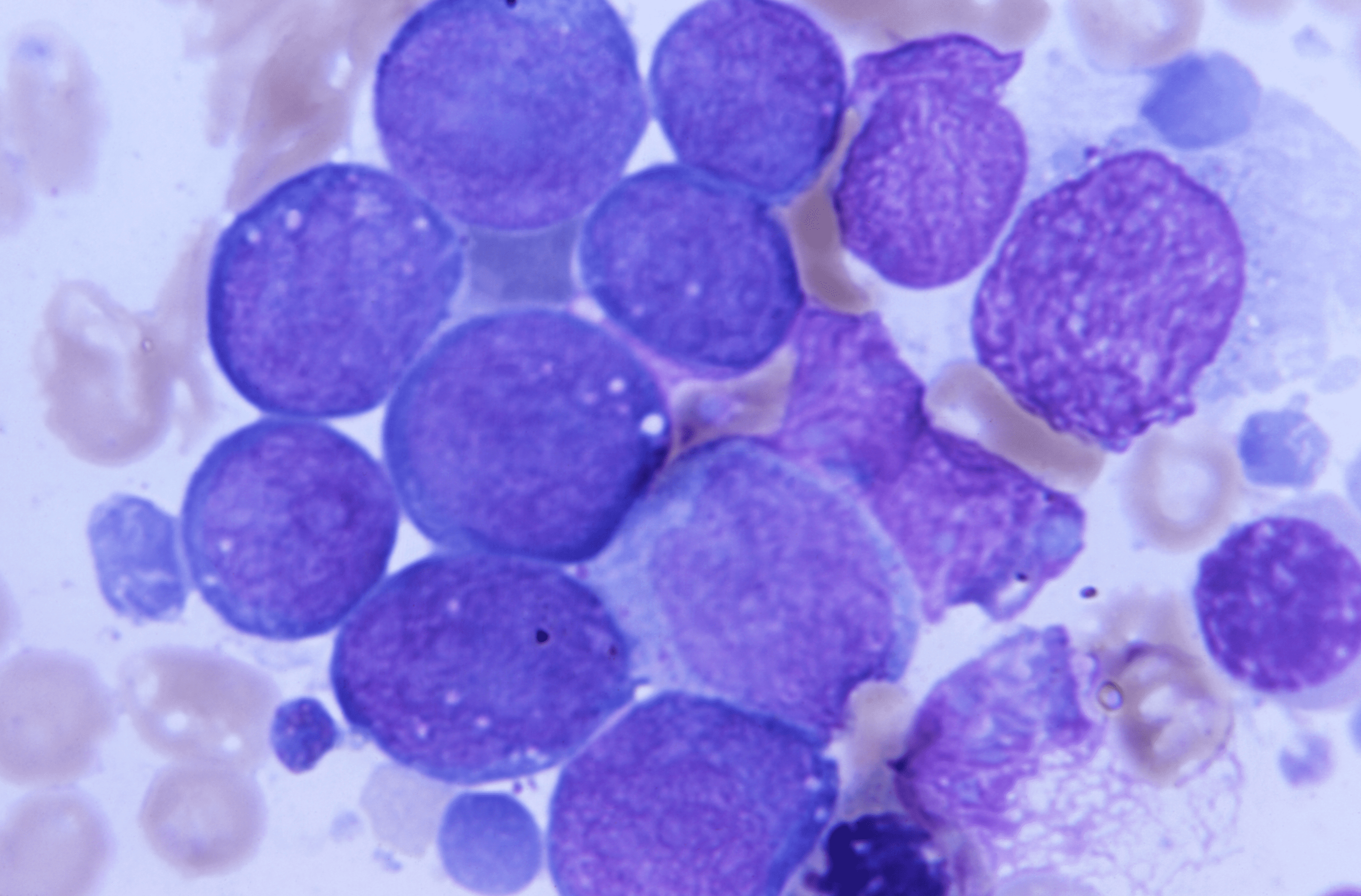 leucemia mieloide aguda