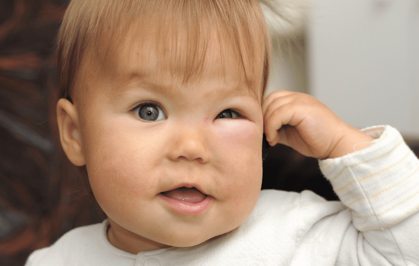 Celulite Facial, Periorbital e Orbital