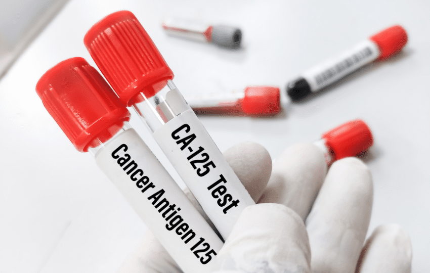 marcador cancer de ovario