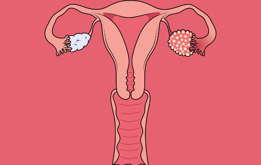 8 de Maio – Dia Mundial do Câncer de Ovário: Um Marco para Revisar Condutas Diagnósticas e Terapêuticas
