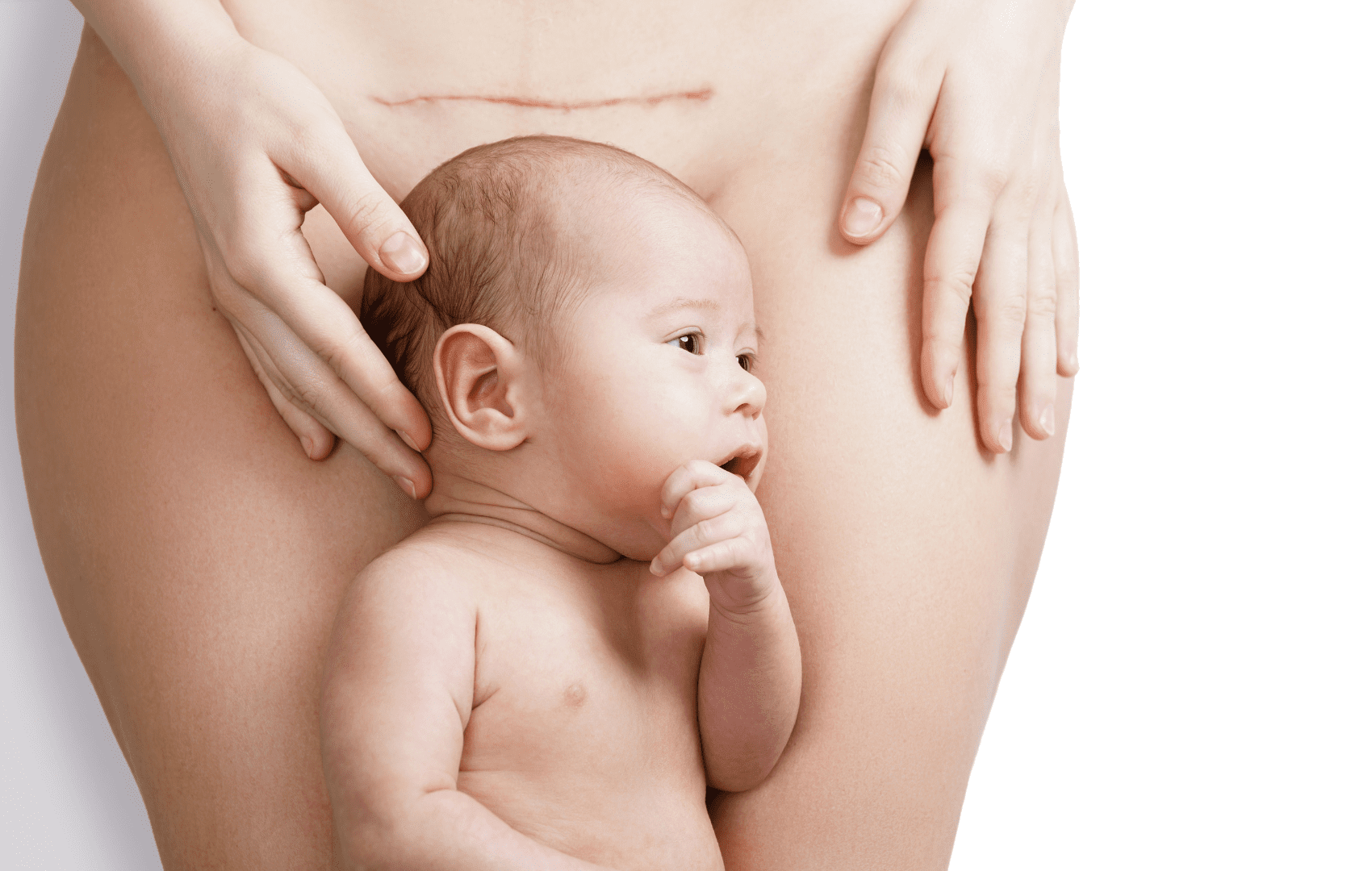 acretismo placentário cesárea