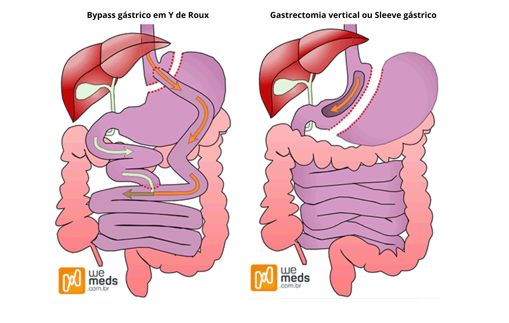 cirurgia bariatrica