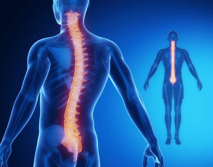 Síndrome de Compressão Medular