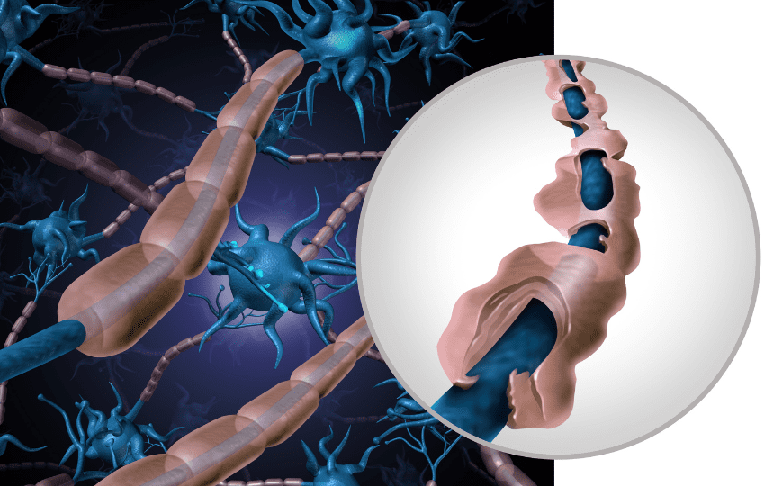 Adrenoleucodistrofia ligada ao X