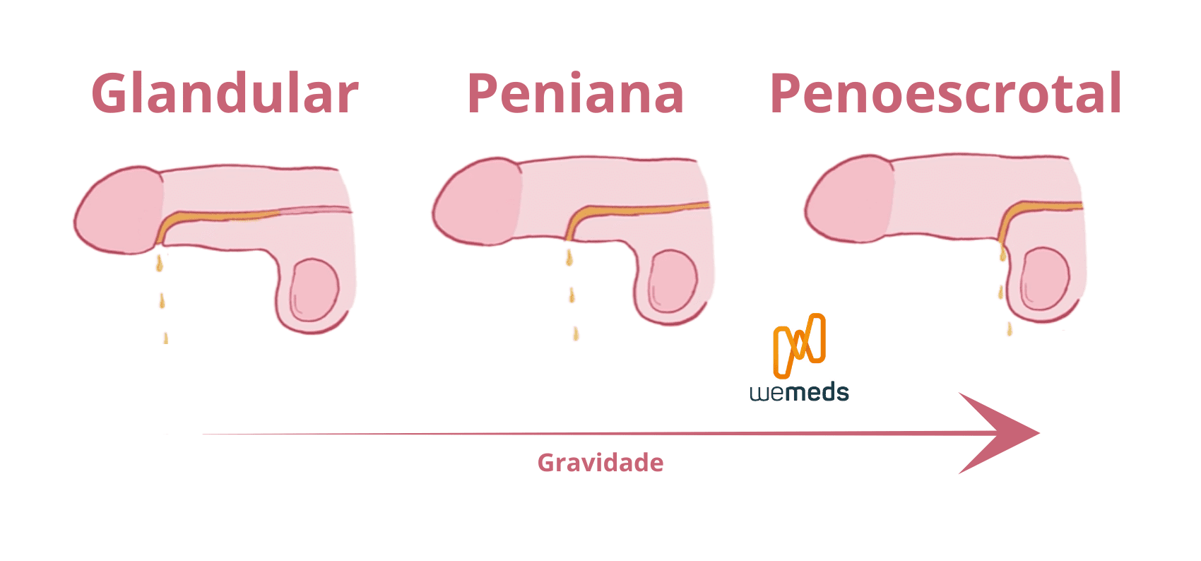 epispádia e hipospadia