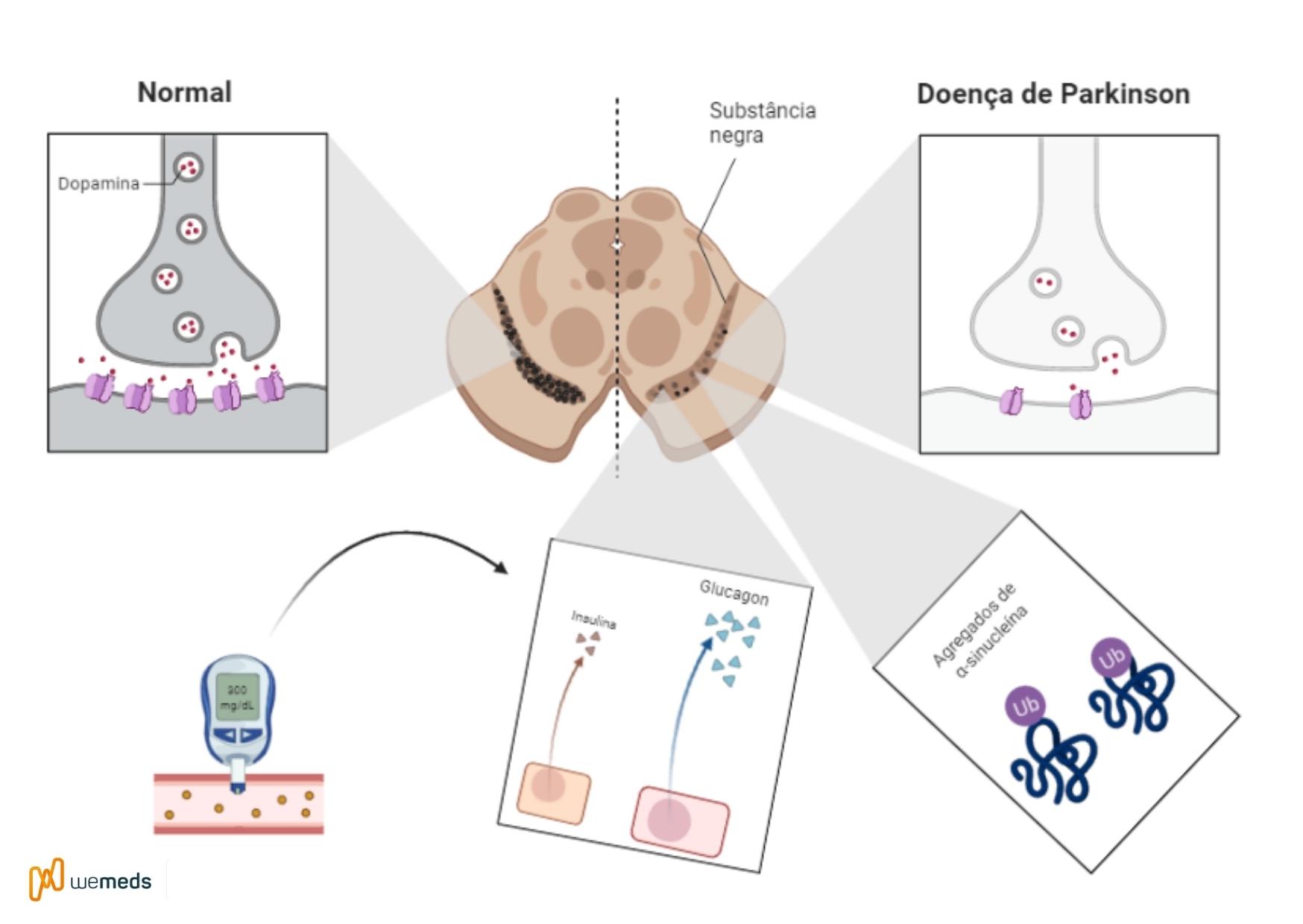 doença de parkinson