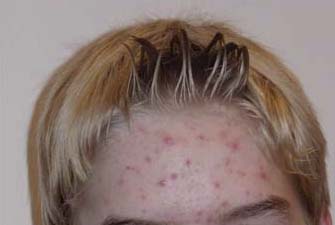 acne grau 2