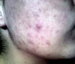 acne grau 3