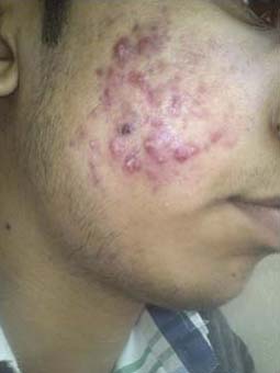 Acne grau 4