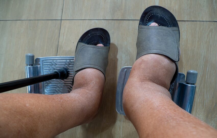 Edema e Linfedema: diferenças fundamentais para o diagnóstico e manejo clínico