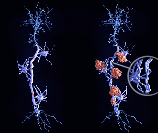 Diagnóstico da Esclerose Múltipla: quando suspeitar e como confirmar