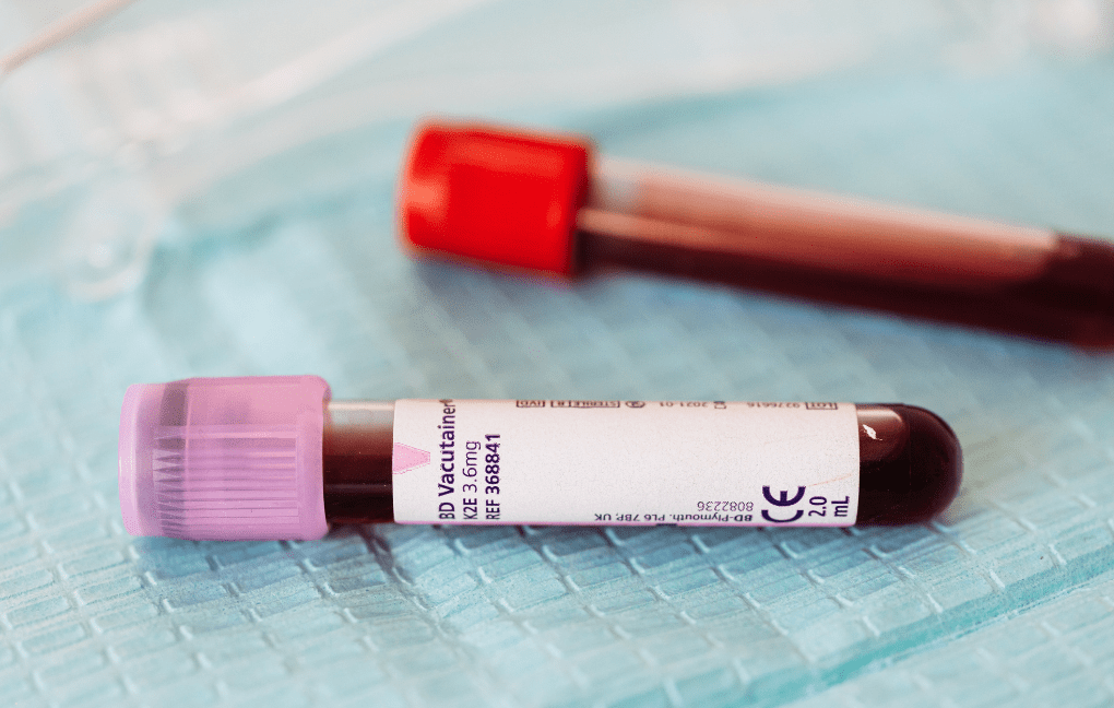 hiponatremia exame de sodio