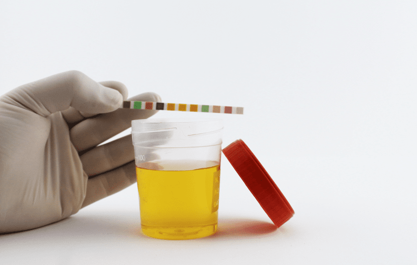 tratamento da nefropatia por IgA