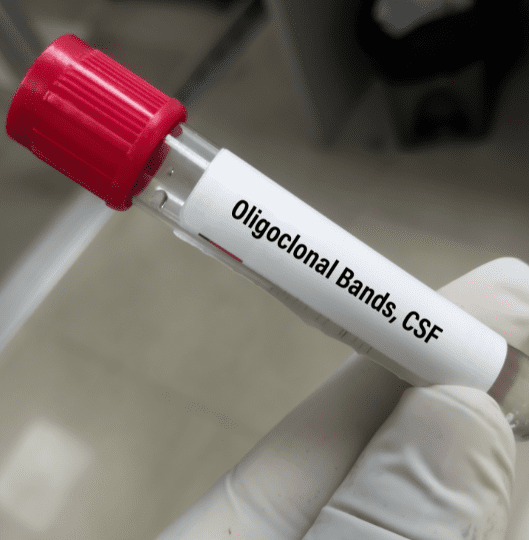 Diagnóstico da Esclerose Múltipla: quando suspeitar e como confirmar