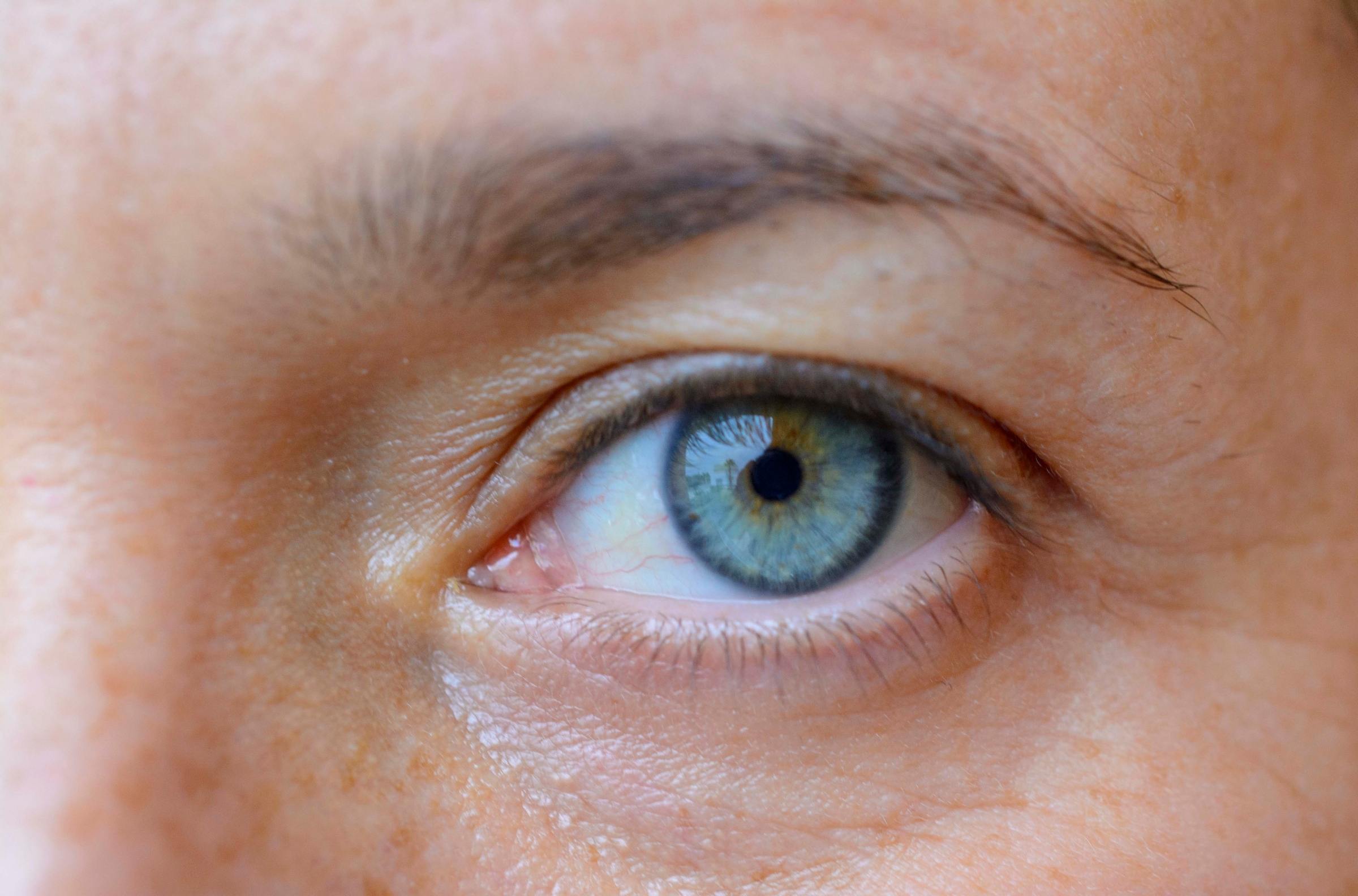 olho depressao ansiedade