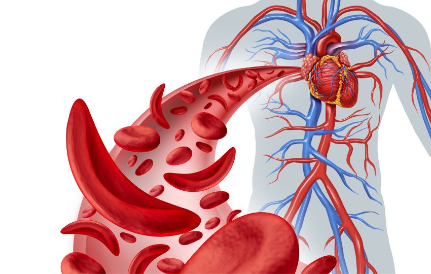 anemia falciforme talassemia tratamento da Doença falciforme