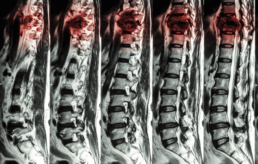 síndrome de compressão medular neoplásica