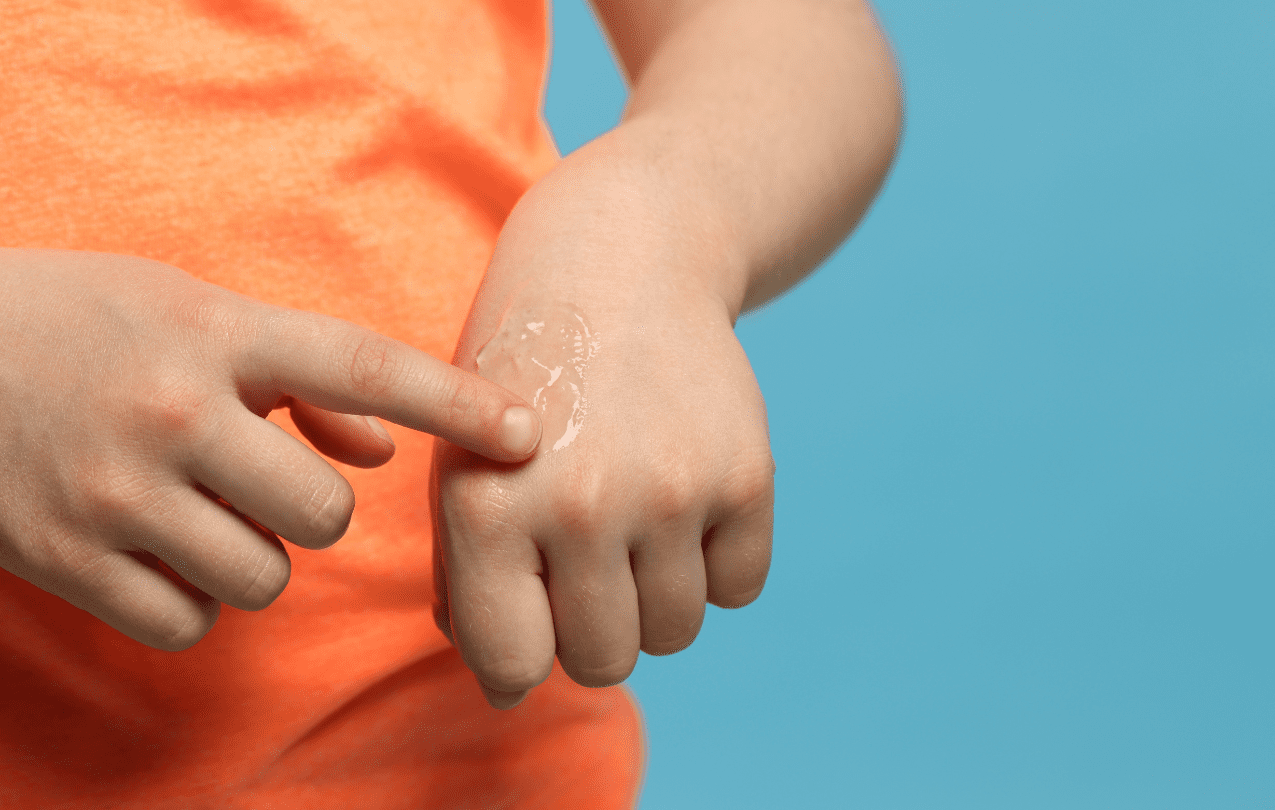 epidermólise bolhosa filsuvez