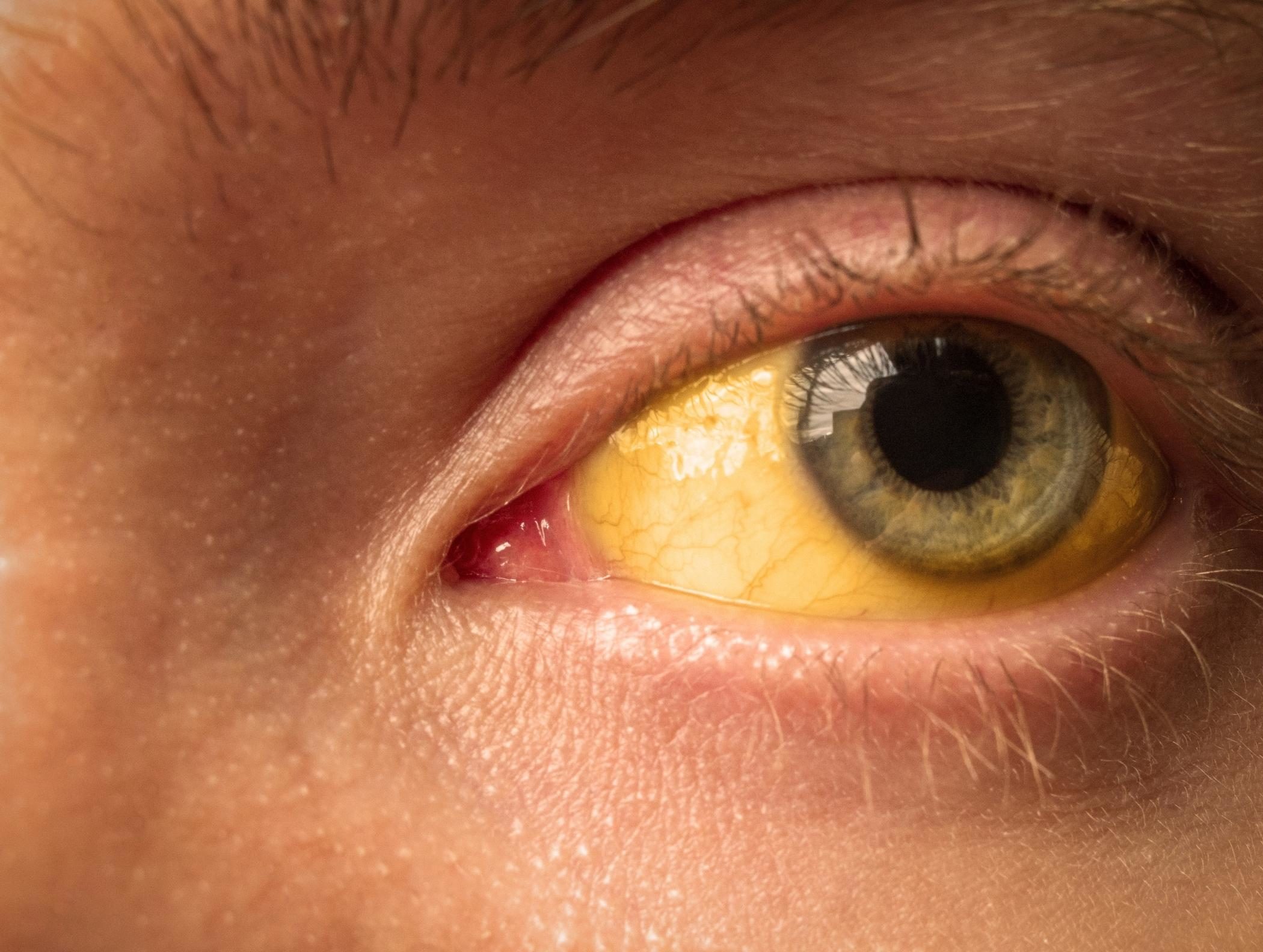 Tríade de Charcot e o diagnóstico da Colangite Aguda