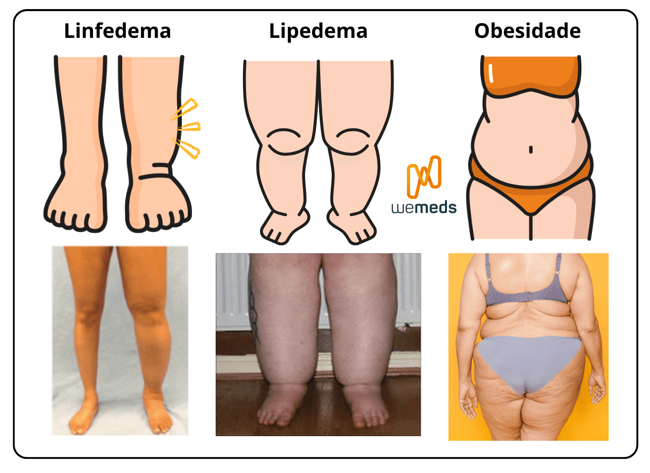 lipedema linfedema obesidade