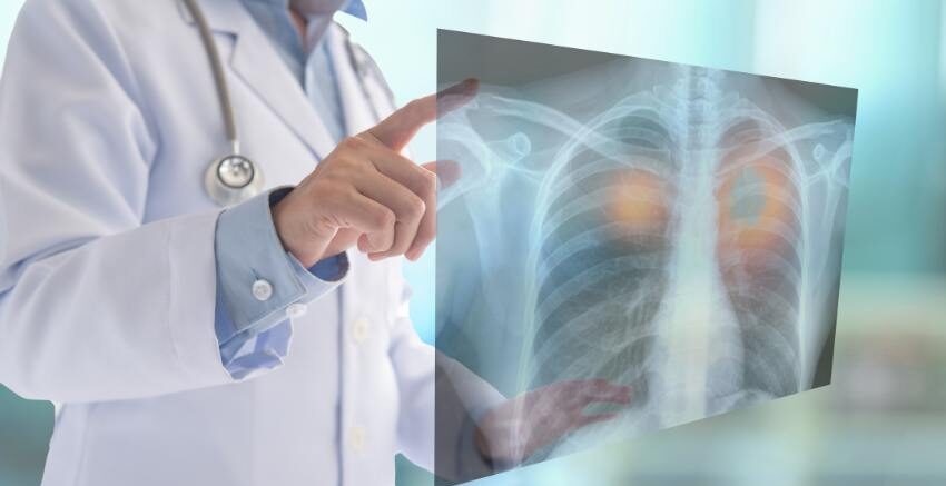 Critérios de Light critério diagnóstico de light exsudativo transudativo exsudato transudato