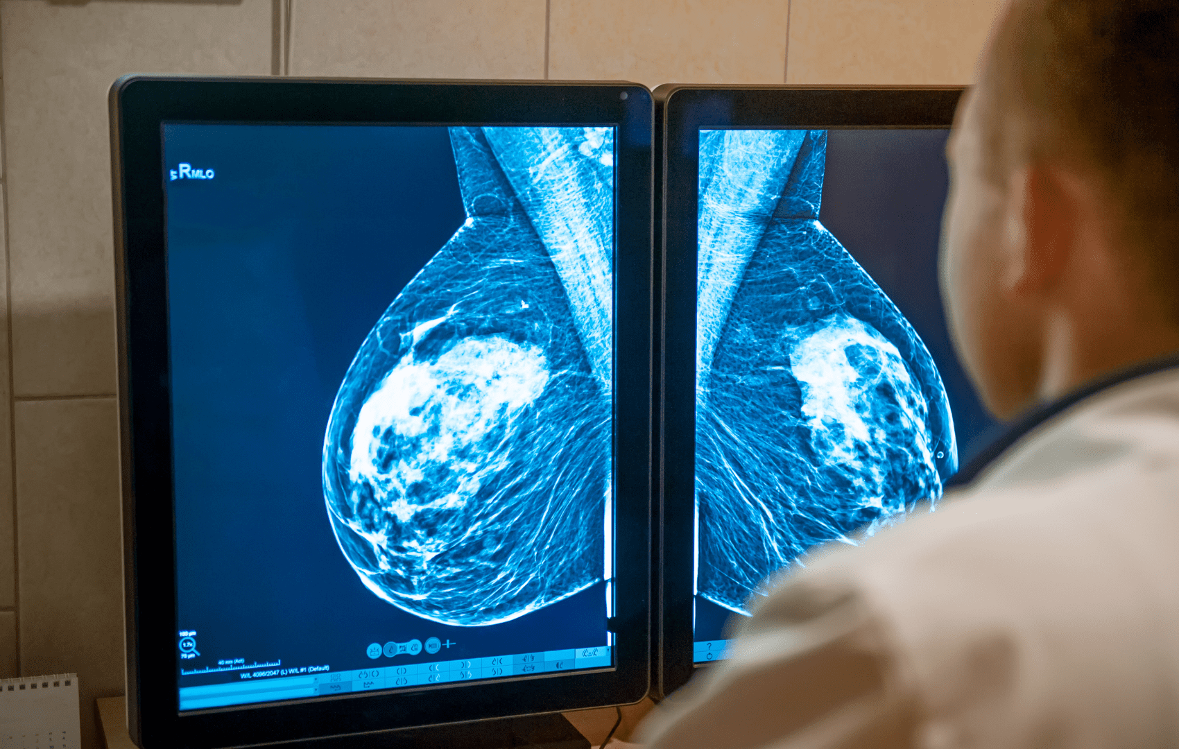 birads Rastreamento do Câncer de Mama