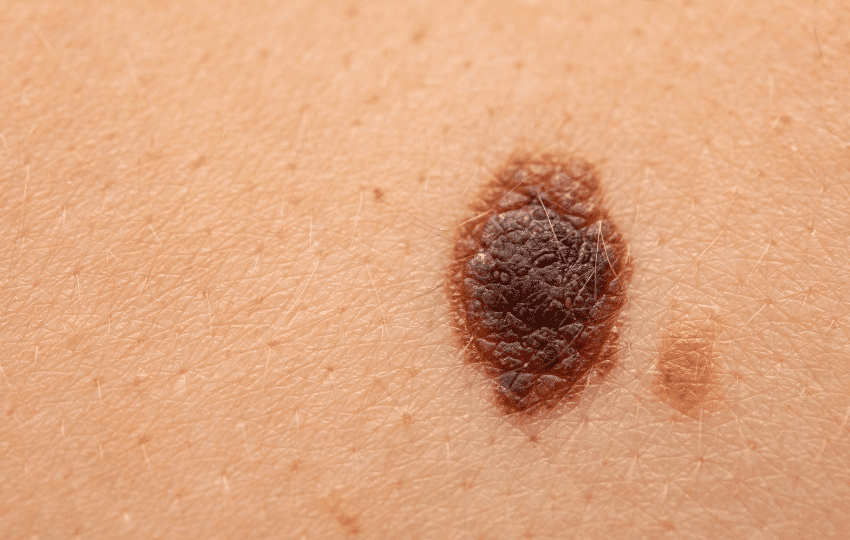 melanoma Talimogene laherparepvec 