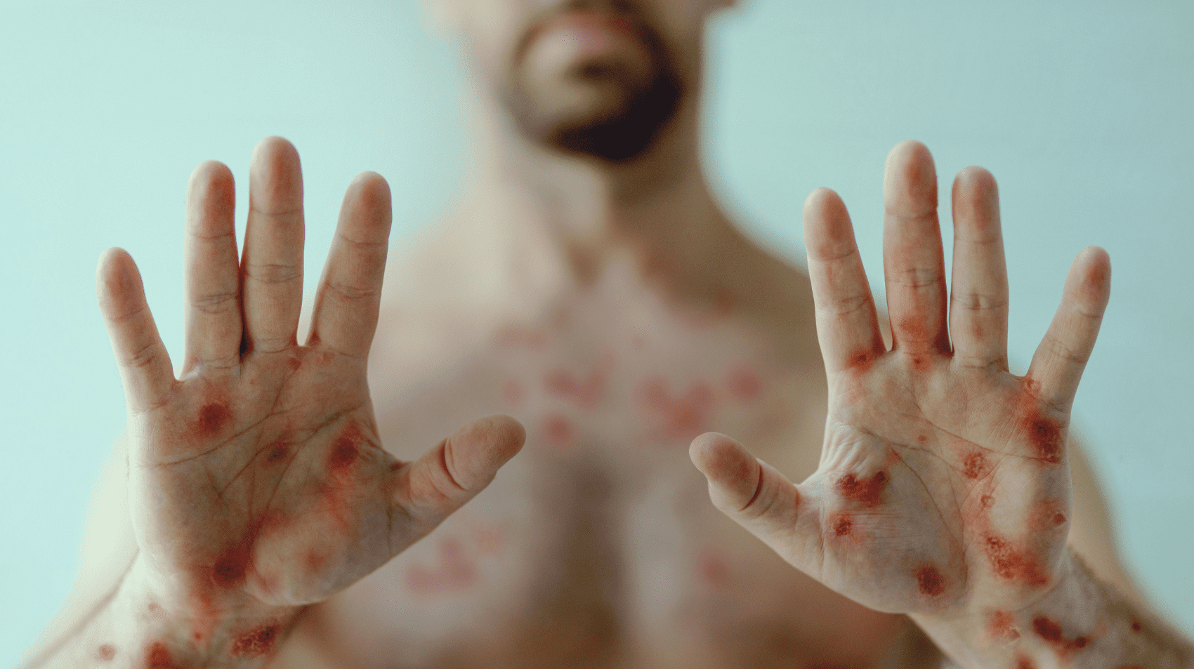 Mpox continua uma emergência de saúde internacional, segundo OMS