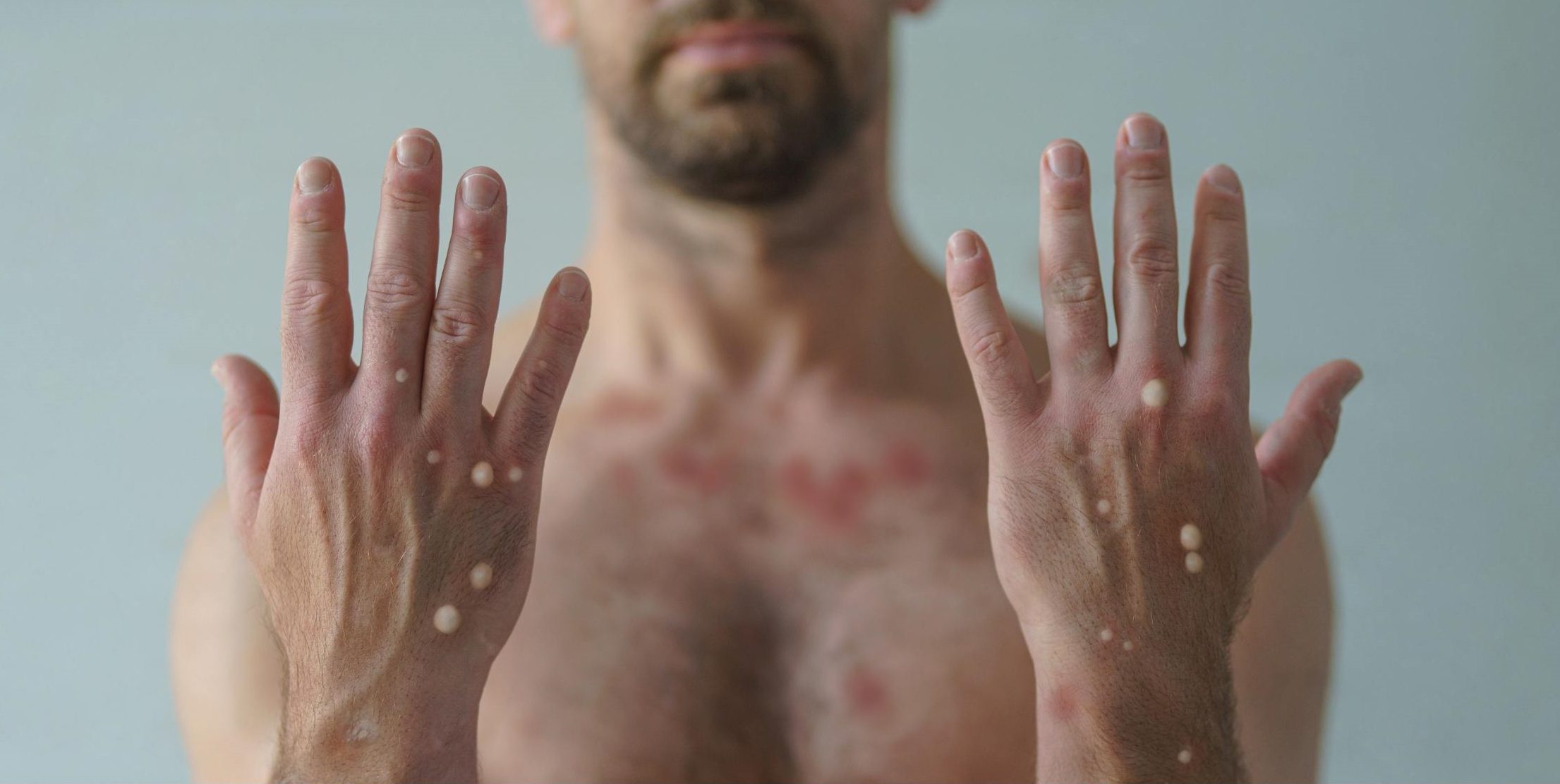 tecovirimat para monkeypox