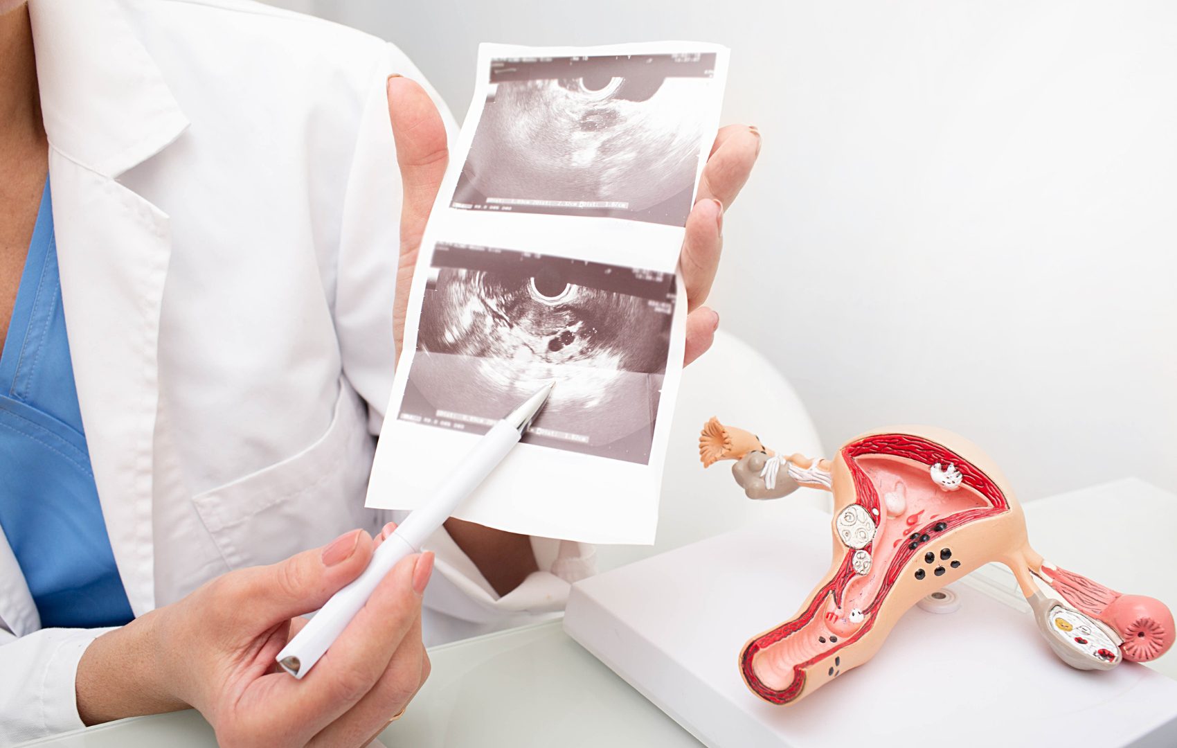 sindrome dos ovarios policisticos Alterações Epigenéticas na SOP