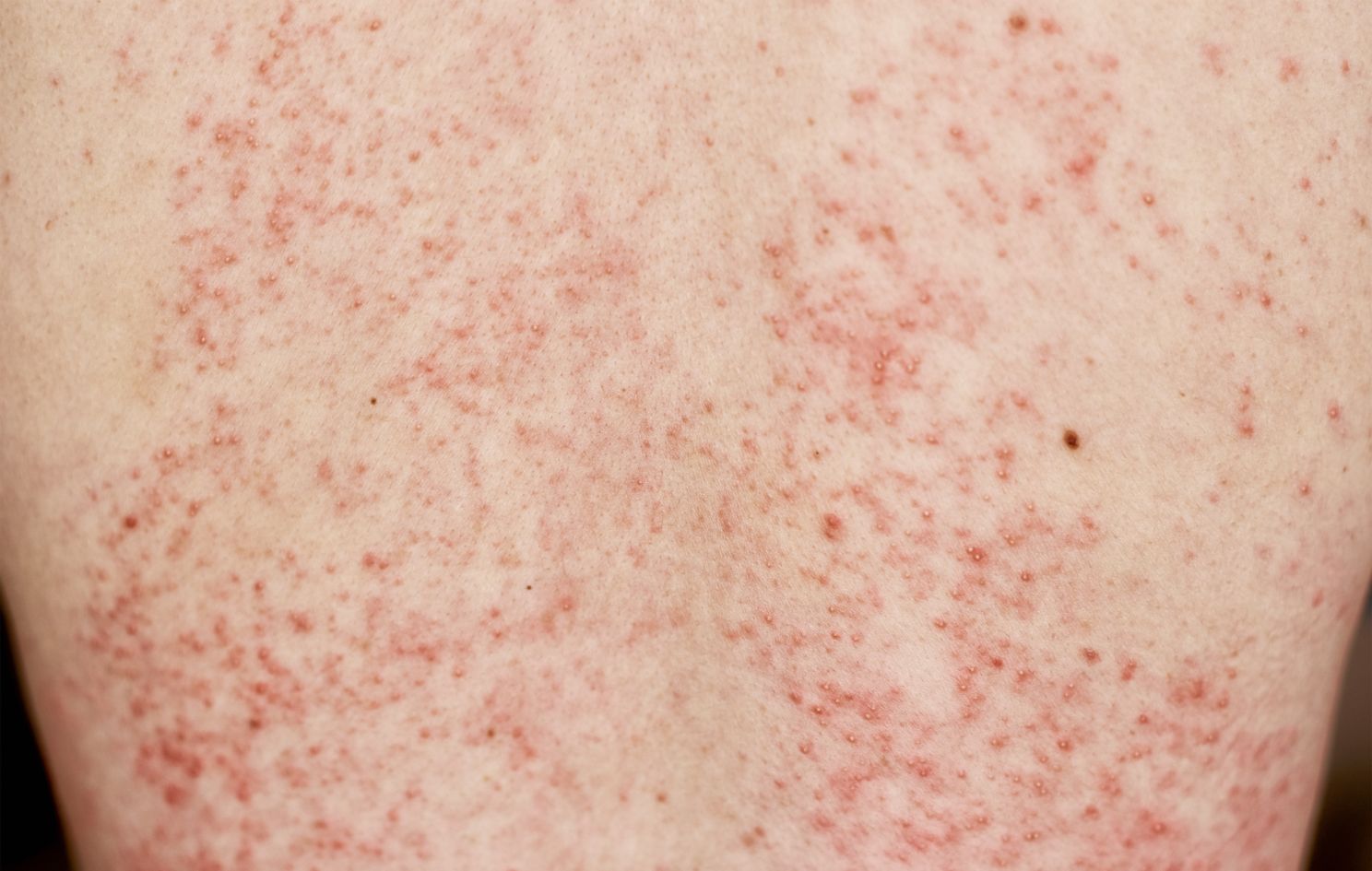 rash cutâneo escarlatina