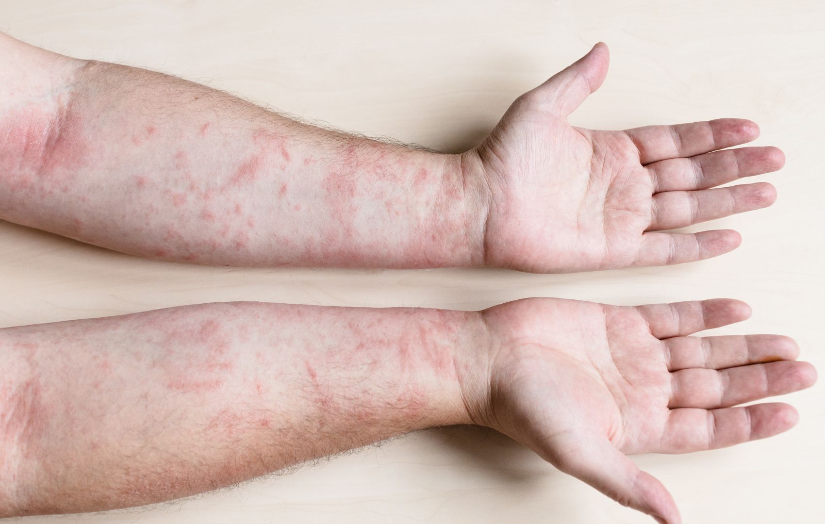 rash cutâneo febre maculosa