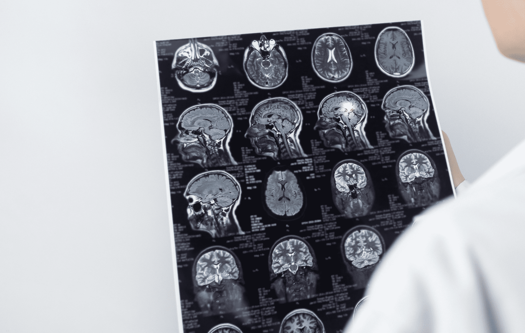 Como utilizar a Escala HUNT-HESS em pacientes com Hemorragia Subaracnoidea