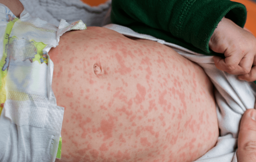 casos de sarampo no rio de janeiro