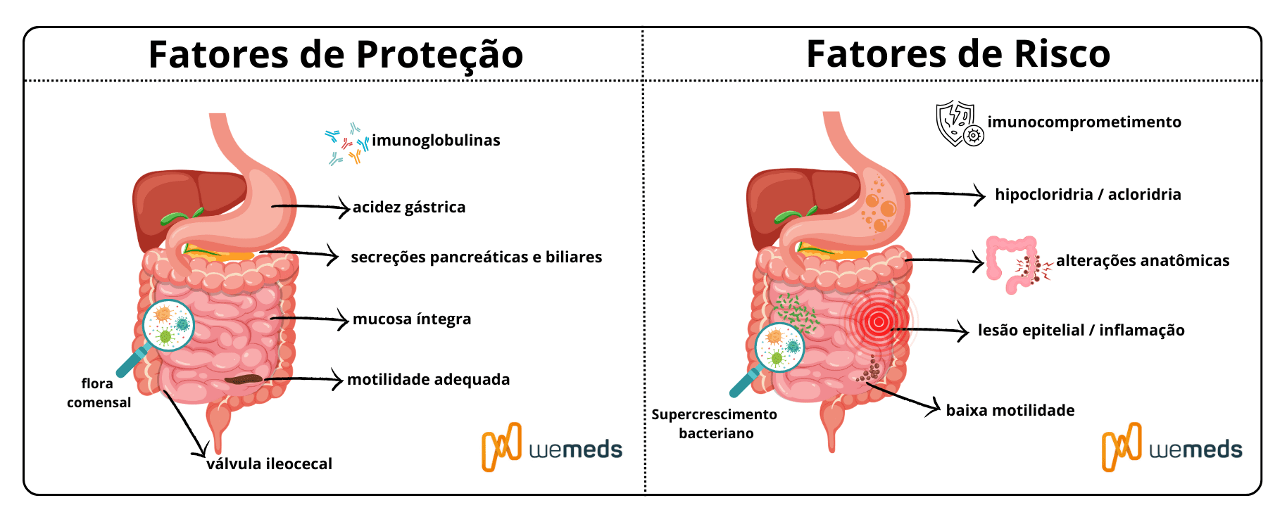 SIBO Supercrescimento Bacteriano no Intestino Delgado 