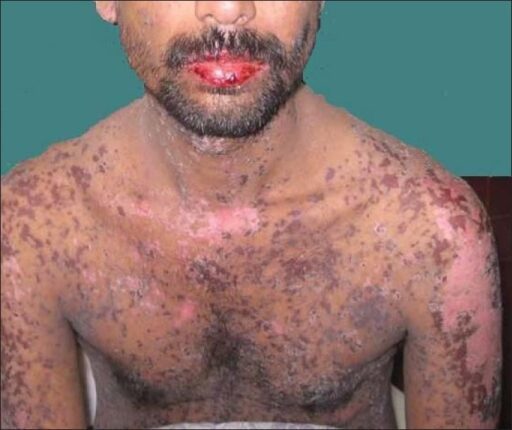 Necrólise Epidérmica Tóxica e Síndrome Stevens-Johnson: 