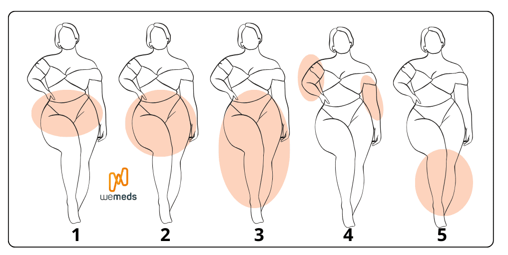 lipedema