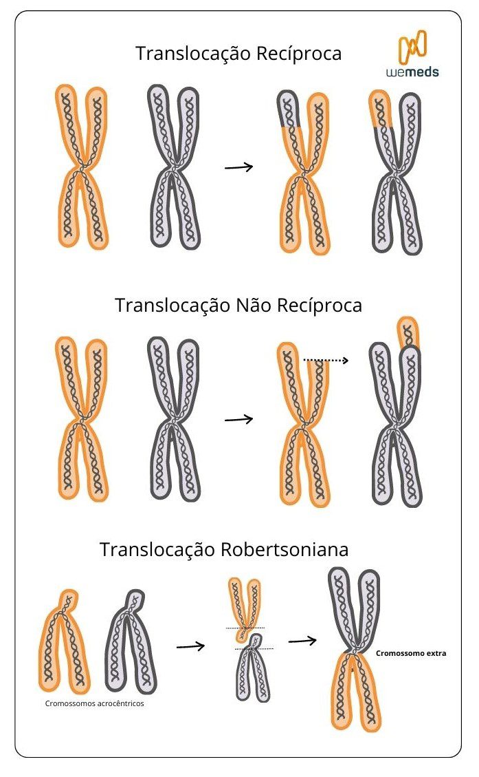 Síndrome de Down - translocação