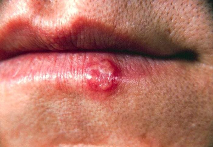 Herpes Labial