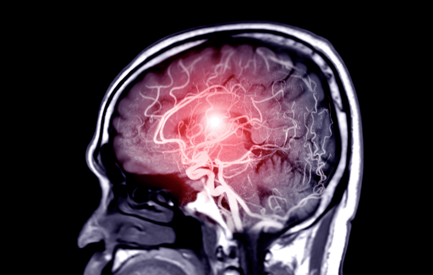 Como utilizar a Escala HUNT-HESS em pacientes com Hemorragia Subaracnoidea