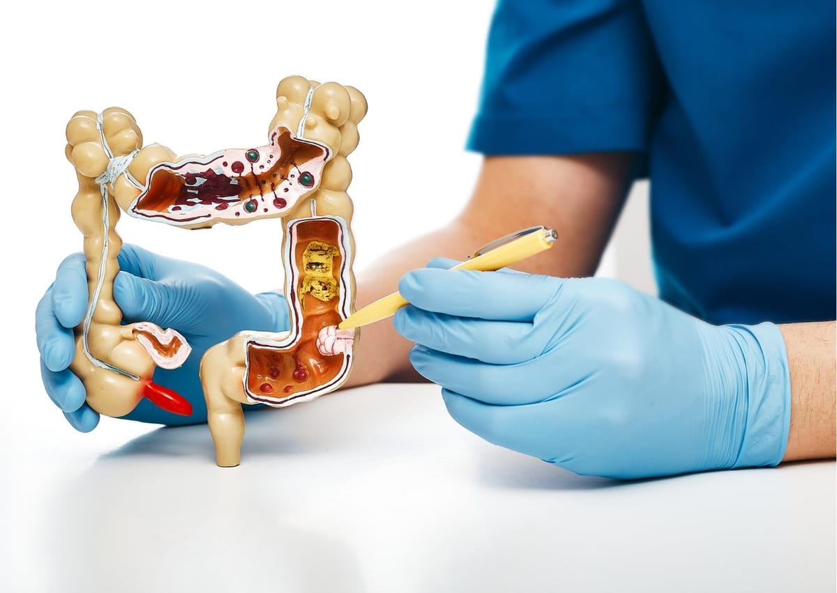 rastreamento de cancer colorretal