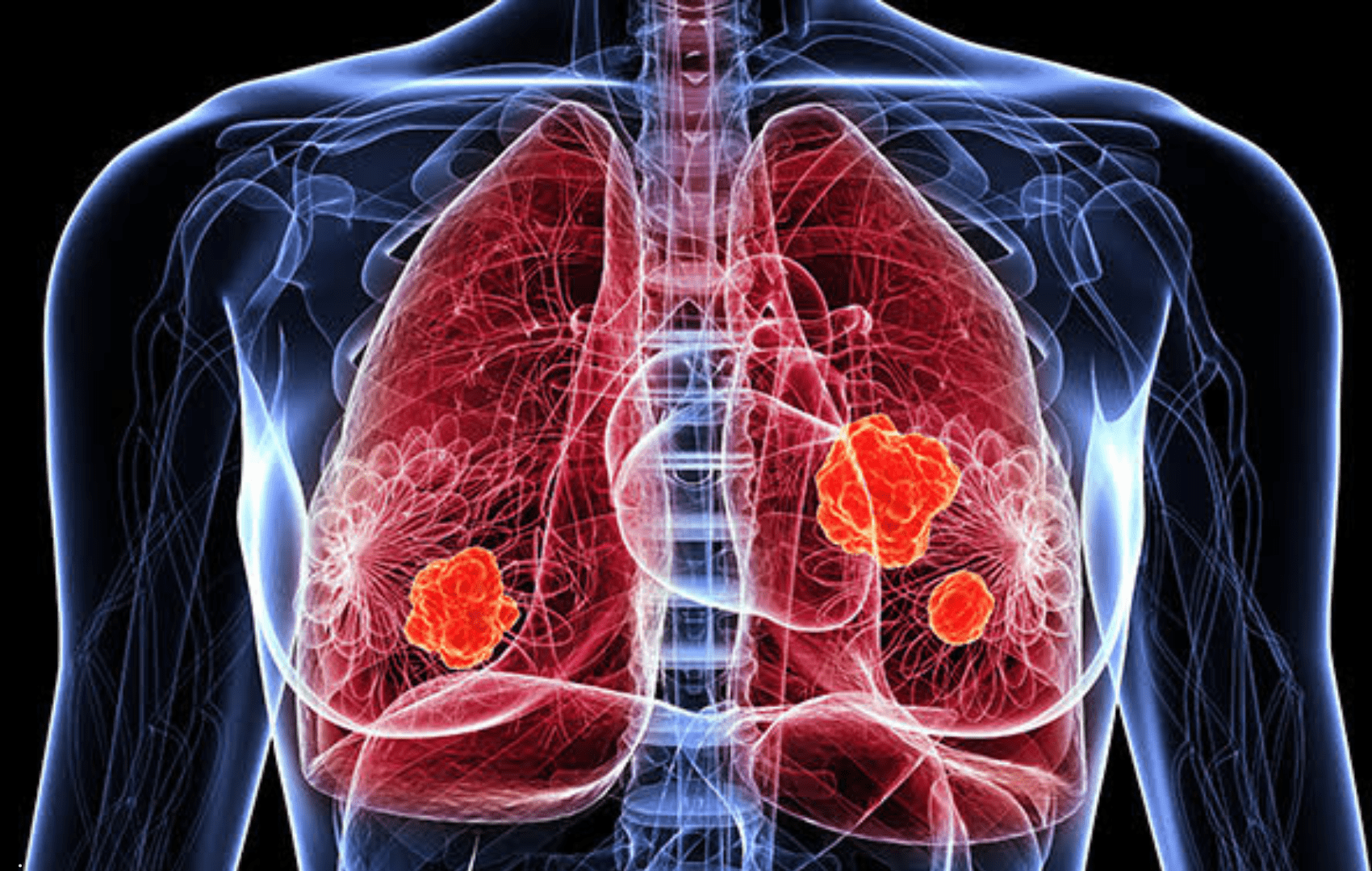 CYFRA 21-1 no Câncer de Pulmão de Células Não Pequenas