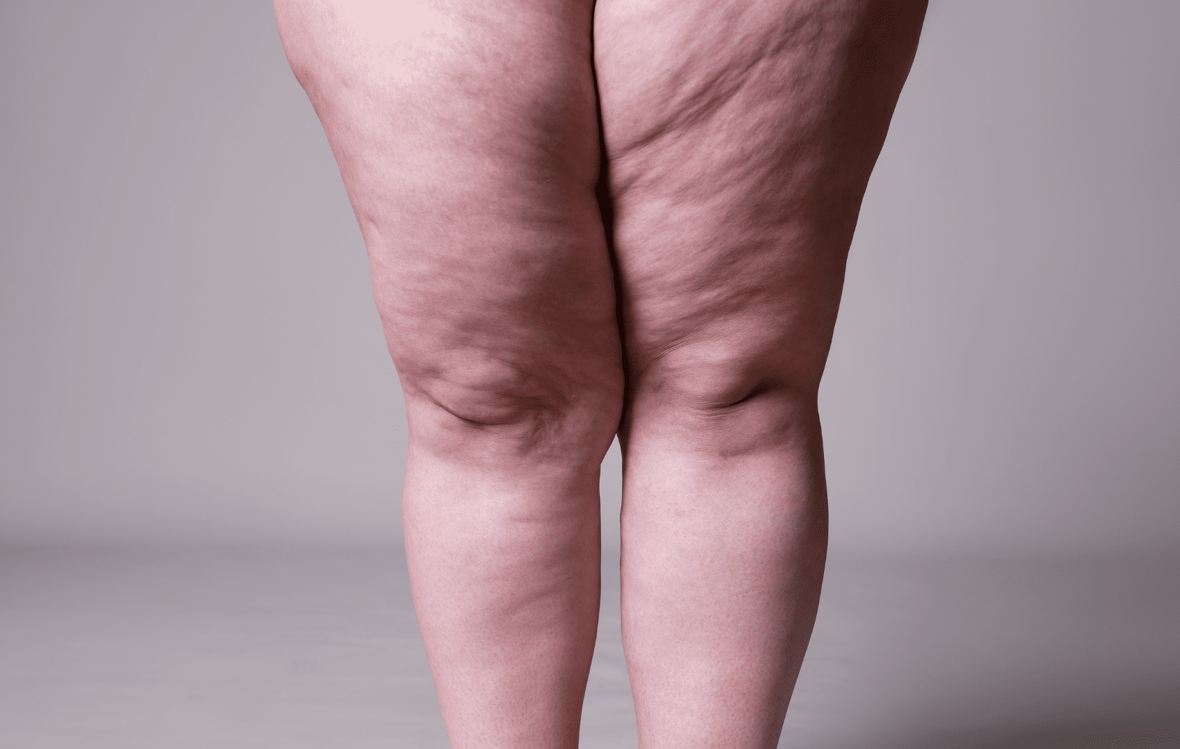 Lipedema: etiologia e fisiopatologia, diagnóstico e tratamento