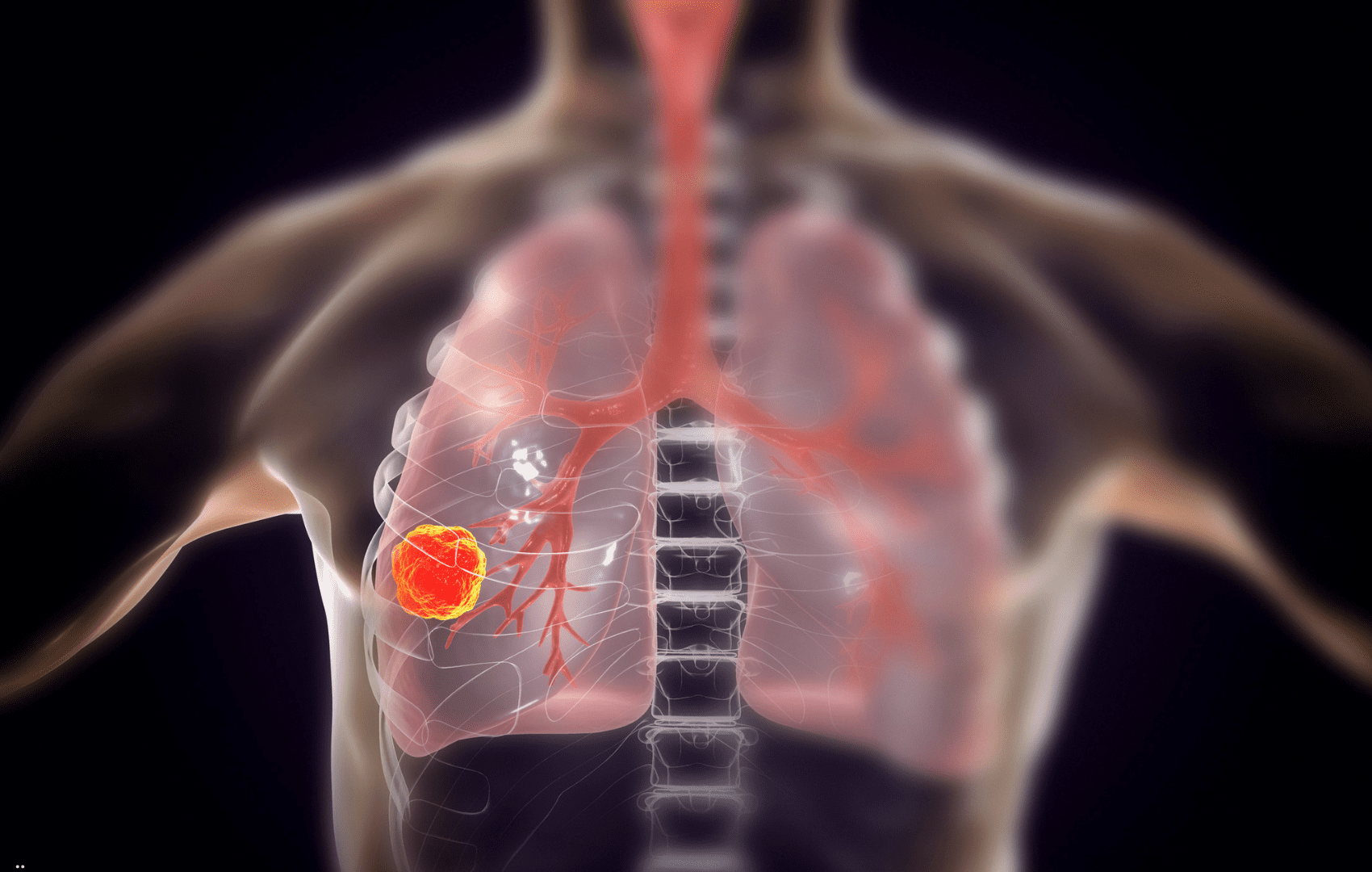 FDA aprova Tarlatamabe (Imdelltra™) para câncer de pulmão de pequenas células