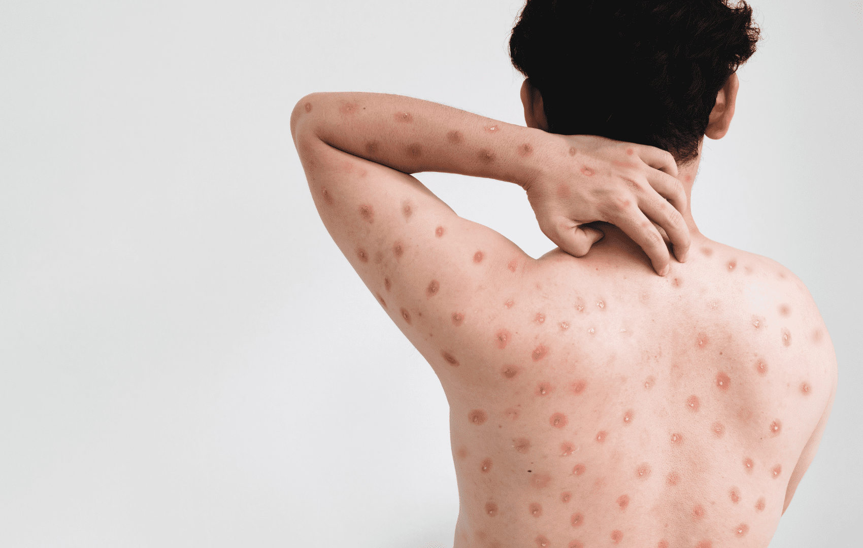 Mpox continua uma emergência de saúde internacional, segundo OMS