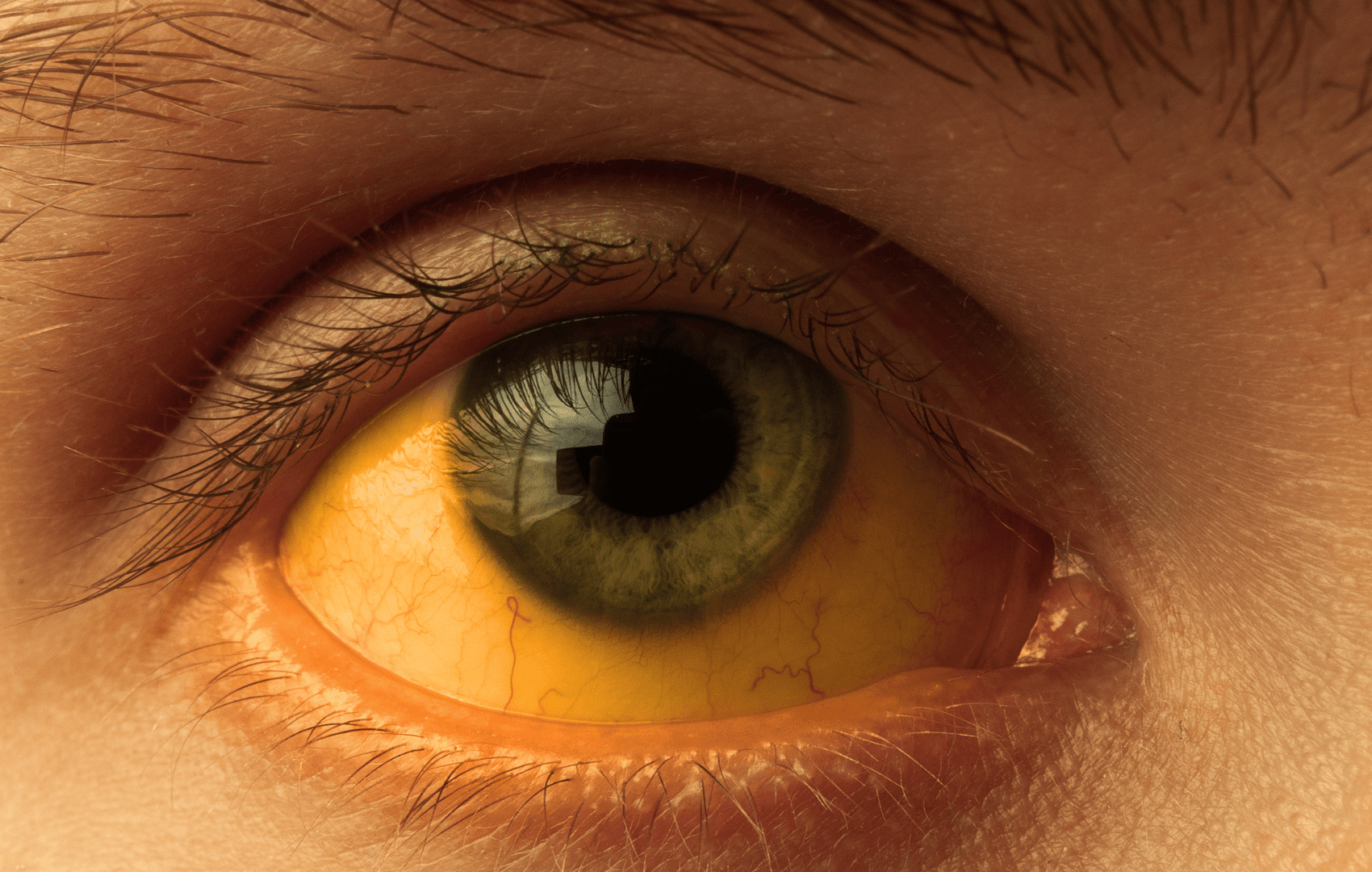 Hepatite A: como diagnosticar?