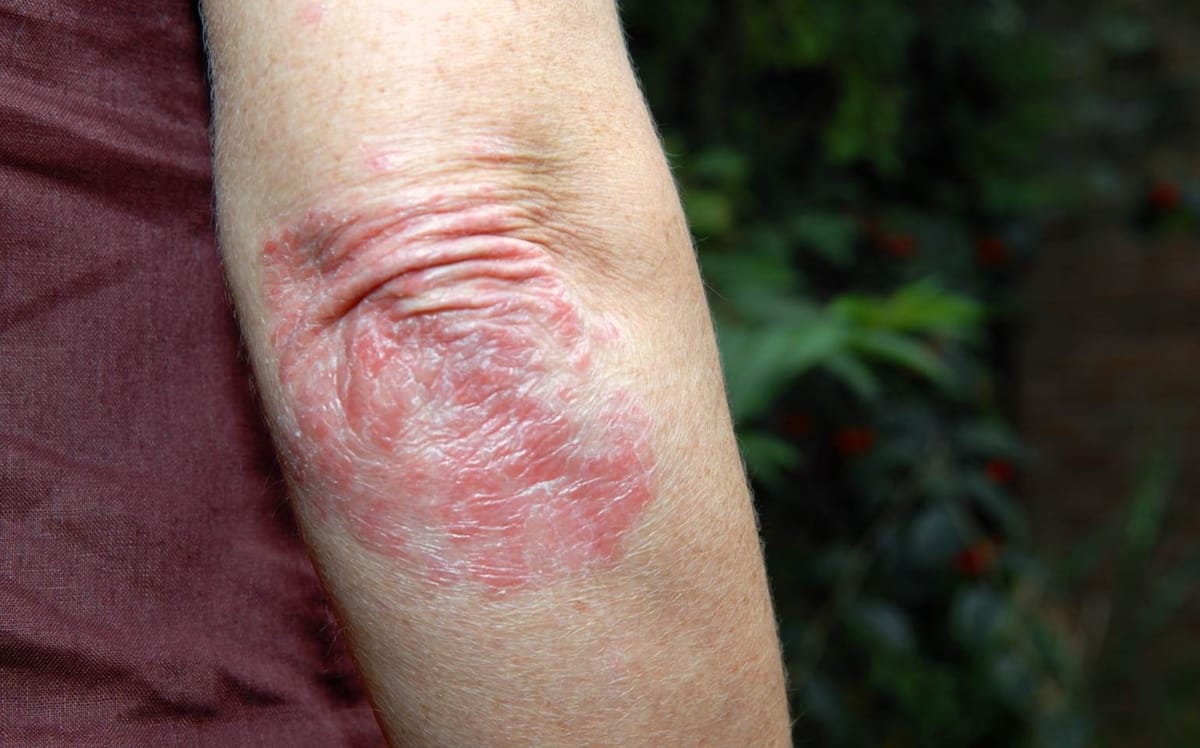 psoriase sotyktu