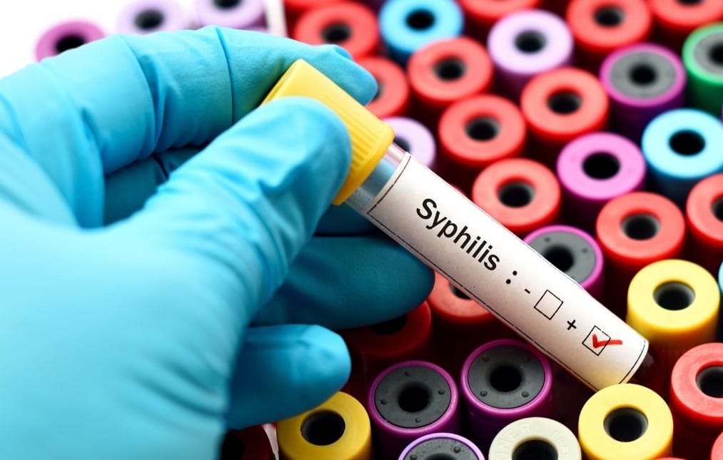 sífilis