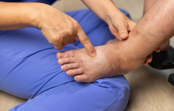 Edema e Linfedema: diferenças fundamentais para o diagnóstico e manejo clínico
